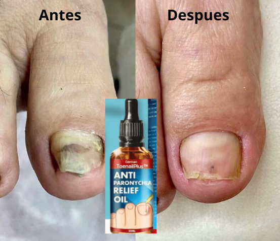 ANTI HONGOS Nail Rescue+®