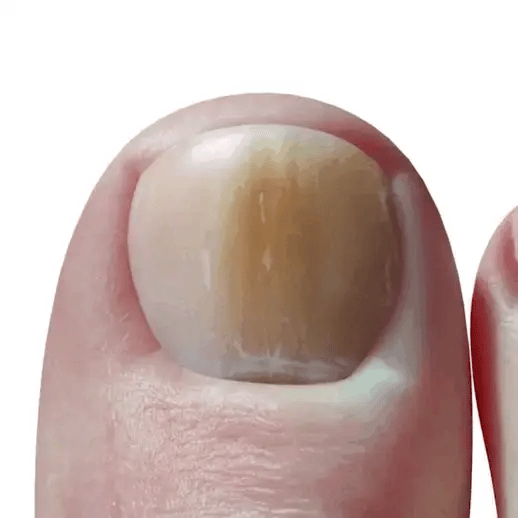 ANTI HONGOS Nail Rescue+®