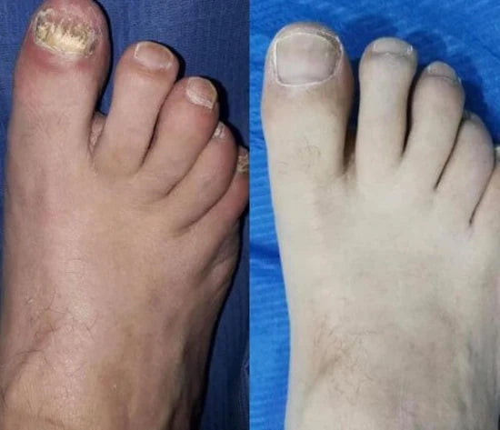 ANTI HONGOS Nail Rescue+®