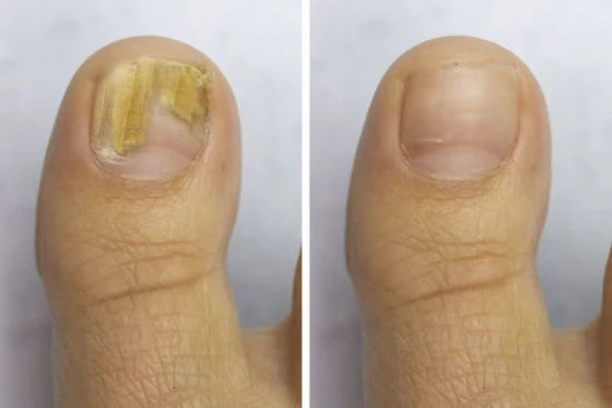 ANTI HONGOS Nail Rescue+®